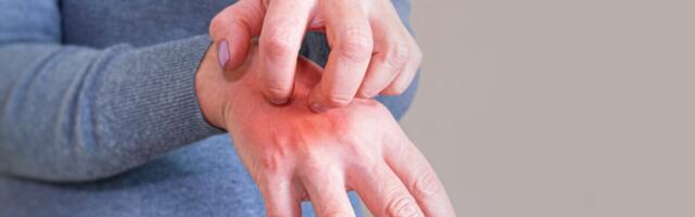 ERR: apteekrid ja arstid täheldavad sügeliste levikut