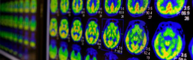 Doktoritöö aitab lahendada Alzheimeri diagnoosimisega seotud vastuolusid