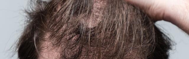 Hämmastav avastus_ tavaline jäätise ja karastusjookide koostisosa aitab juuste väljalangemise vastu