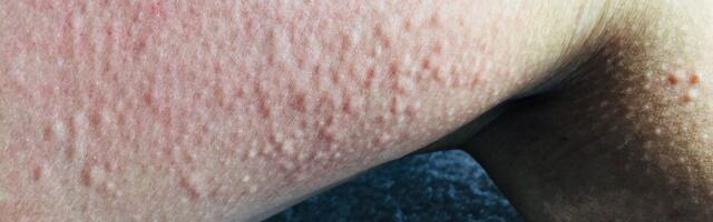 Külmaallergia: kuidas suvekuumust üle elada, kui end jahutada ei saa