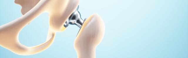 Tervisekassa alustas endoproteesimise raviteekonna parandamist