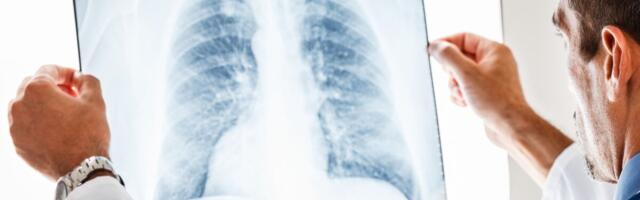 Lõppes kaks aastat kestnud üleriigiline kopsuvähi andmete koondamise teostatavusuuring