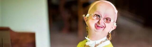 FOTOD JA VIDEO ⟩ Lugu naisest, kes on haruldase haiguse tõttu lapse kehas lõksus