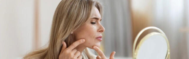 Akne tekke põhjuseks on toit ja ravida saab toiduga