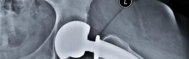 Endoproteesimise teekond aitab inimesed operatsioonile varasemast kordi kiiremini