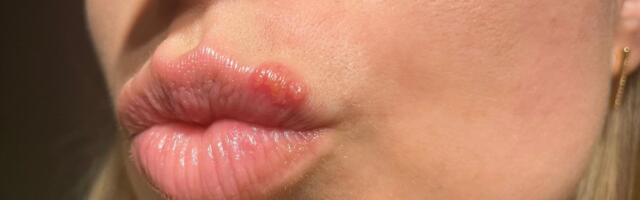 Äärmiselt valus ja ebameeldiv. Suvi soodustab ohatise tekkimist - kuidas seda kõige tõhusamalt ravida?