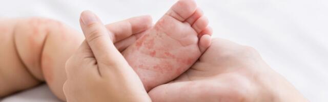 Leetrite juhtumite arv hüppas lakke