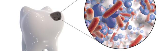 Iidne hambaleid aitab mõista toitumismuutuste mõju hambaaukude tekkele