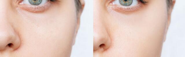 Silmalaugude plastika – lihtne operatsioon, mis võib sinu väsinud näoga imesid teha