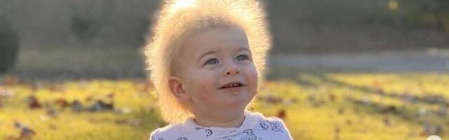 Väiksel poisil on haruldane seisund, mistõttu ei saa ta juukseid kammida