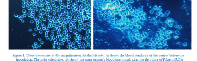Uus uuring: 94%-l hilisemate terviseprobleemidega ja vaktsineeritud patsientidel esines veres anomaaliaid