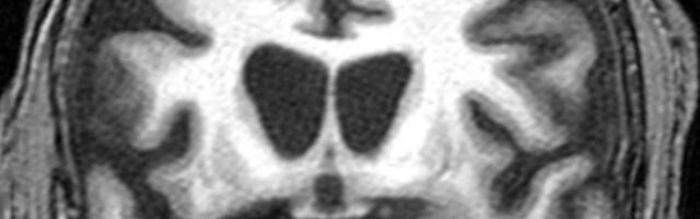 Läbimurre: teadlased suutsid geeniteraapia abil surmava Huntingtoni tõve arengut aeglustada neli korda