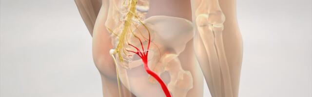 Uuring: ishiase puhul on endoskoopiline operatsioon sama tulemuslik kui traditsiooniline