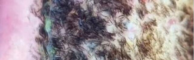 Mehe keel muutus pärast insulti mustaks ja karvaseks