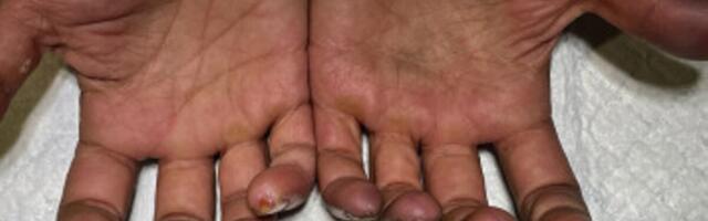 Liigne kanepisuitsetamine võttis mehelt peaaegu sõrmed