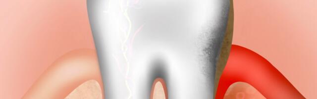 Delfi: Lastele tehtavad igemeprotseduurid tekitavad küsimusi