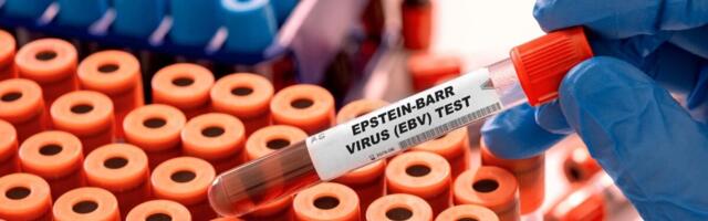 Uuring: Epstein-Barri viirus võib olla luupuse tekke otsene mehhanism