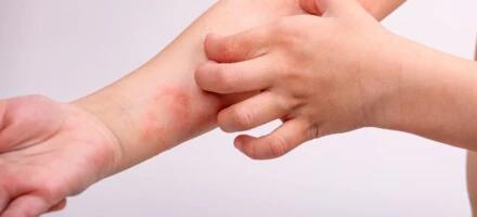 Eestis levivad sügelised!