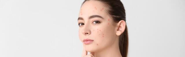 Akne ravi tuleb alustada varakult