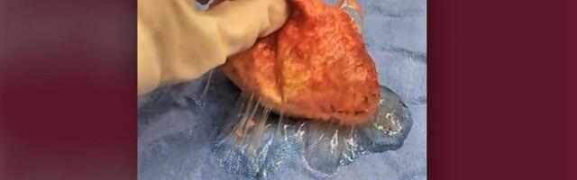 Sellised näevad välja 35 aastat rinnas olnud implantaadid