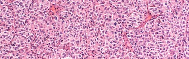 FDA kiitis heaks raskesti ravitava metastaatilise melanoomi uue ravi