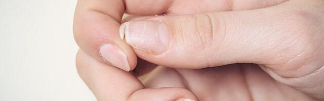 Selliste koostisosadega kätekreemi peaks talvel kasutama, et vältida infektsioone ja küünte murdumist 