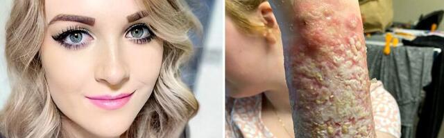 Mürgiämbliku hammustus jättis naisele kohutava haava, võlad ja vähiriski